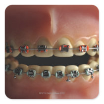 A dental model and Teeth braces Square Stickers