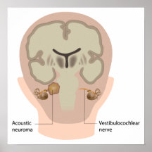 Acoustic neuroma Poster