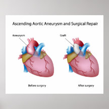 Ascending aortic aneurysm surgery Poster