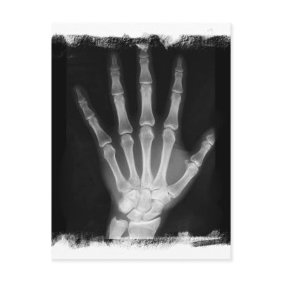 B&W X-ray Skeleton Hand by VoXeeD