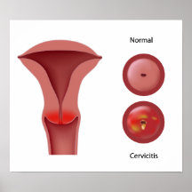 Cervicitis cervix infection Poster