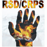CRPS/RSD Awarness Blazing Hand Photo Sculpture photo sculptures