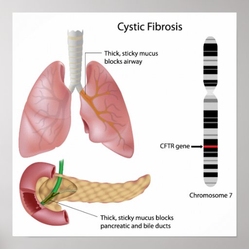 Gene Therapy Cystic Fibrosis Treatment
