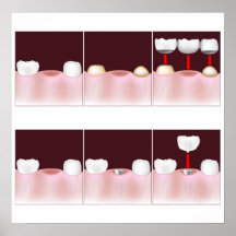 Dental implants vs fixed bridge, add your text! posters
