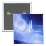 Elbow xray with screws button