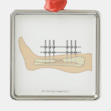 External Fixator Christmas Tree Ornaments