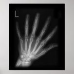 Extra Digit X-ray Left Hand posters