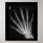 Extra Digit X-ray Right Hand posters