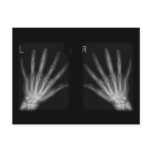 Extra Digit X-ray Right & Left Hands Post Cards