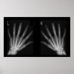 Extra Digit X-ray Right & Left Hands posters