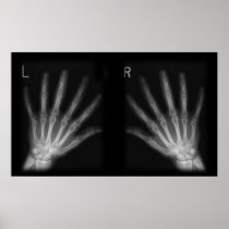 Extra Digit X-ray Right & Left Hands Posters