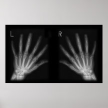 Extra Digit X-ray Right & Left Hands Posters