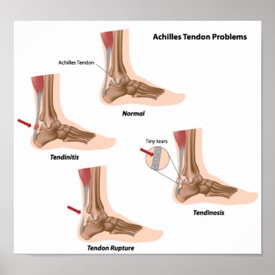 Foot Tendon Pain