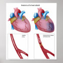 Heart attack Any size Poster posters