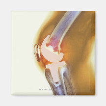 Knee replacement. Coloured X-ray of a total knee Fridge Magnets
