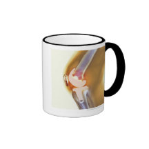 Knee replacement. Coloured X-ray of a total knee Mugs