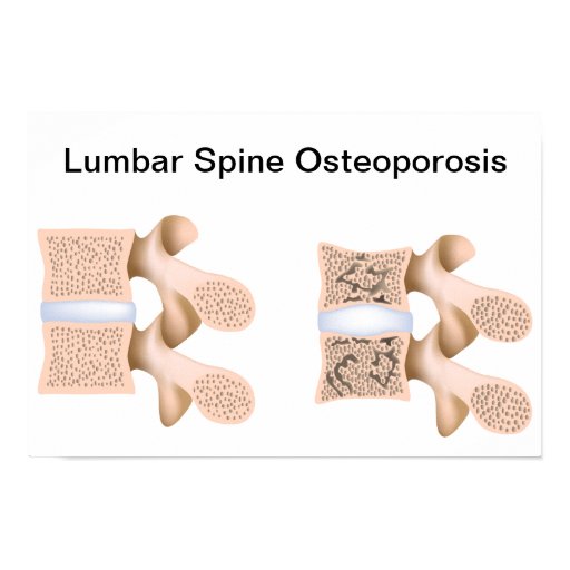 Lumbar spine osteoporosis Poster Zazzle