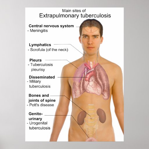 Main Symptoms Of Extrapulmonary Tuberculosis Chart Posters Zazzle 