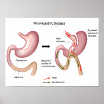 Mini gastric bypass surgery Poster