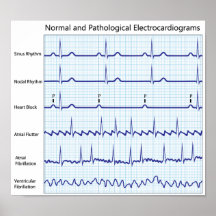 Normal and pathological ecg Poster