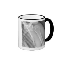 Normal shoulder. X-ray of the healthy left Coffee Mugs