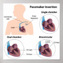 Pacemaker insertion surgery Any size Poster posters