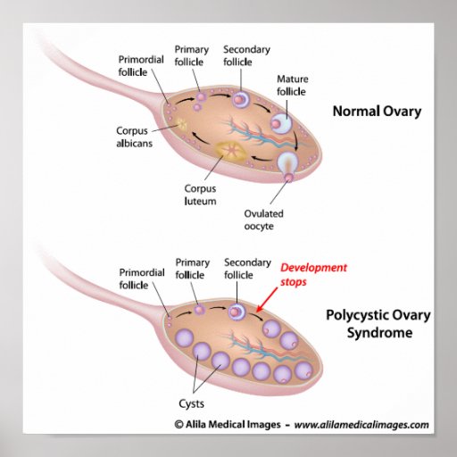 Polycystic Ovary Syndrome  Labelled Diagram