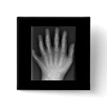 Polydactyly, Six Fingered Hand, X-Ray, rarity! buttons