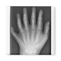 Polydactyly, Six Fingered Hand, X-Ray, rarity! Magnets