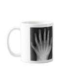 Polydactyly, Six Fingered Hand, X-Ray, rarity! mugs
