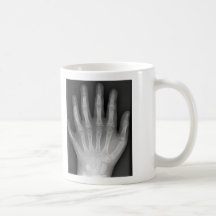 Polydactyly, Six Fingered Hand, X-Ray, rarity! Coffee Mug