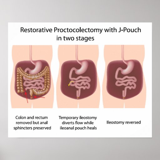 Restorative proctocolectomy with jpouch 2 stages poster