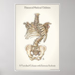 Scoliosis Spine posters