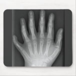 Six Fingered Hand, Medical Rarity, X-Ray mousepads
