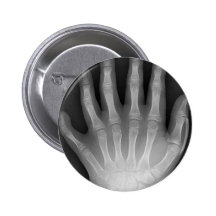 Six Fingered Hand, Medical Rarity, X-Ray Pin
