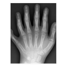 Six Fingered Hand, Medical Rarity, X-Ray Post Cards