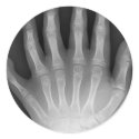 Six Fingered Hand, Medical Rarity, X-Ray stickers