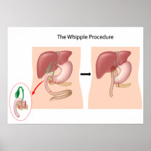 The Whipple Procedure Poster