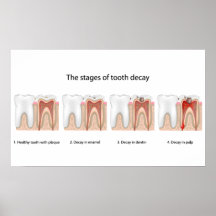 Tooth decay Poster