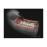 View of an angioplaty balloon in an artery post cards