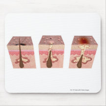 View of what causes acne mouse pad