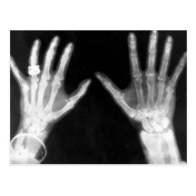 X-Ray Skeleton Hands & Jewellery - B&W Post Card