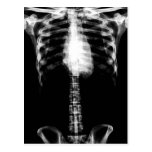 X-RAY SKELETON TORSO RIBS B&W POSTCARD