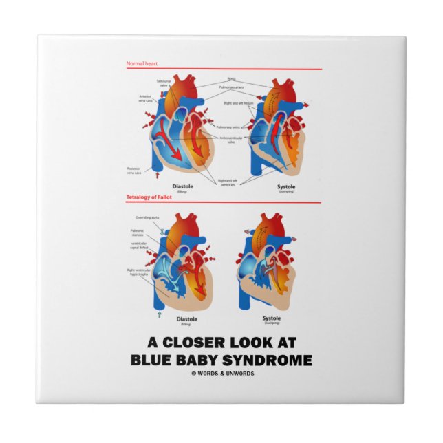 A Closer Look At Blue Baby Syndrome Heart Anatomy Tile (Front)