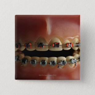 A dental model and Teeth braces 15 Cm Square Badge