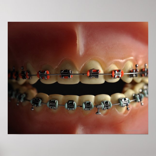 A dental model and Teeth braces Poster (Front)