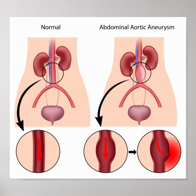 Abdominal Aortic Aneurysm poster (Front)