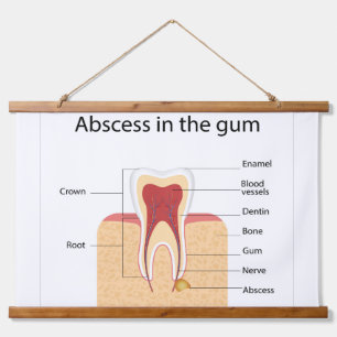 Abscess in the gum hanging tapestry