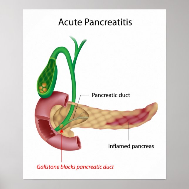 Acute Pancreatitis Poster (Front)