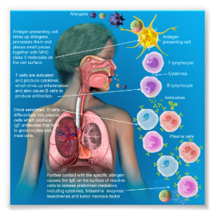 Allergies: IgE inflammatory response poster